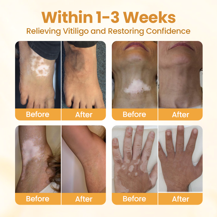 Oveallgo® VitiClear Bee Venom Cream