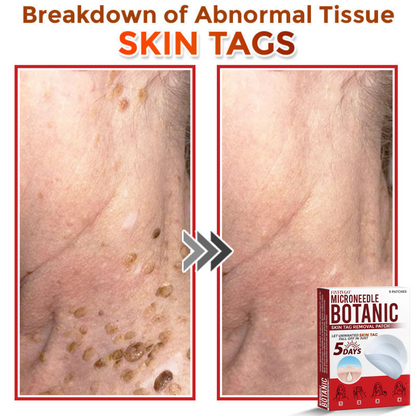 Fivfivgo® MicroNeedle Botanic Skin Tag Removal Patch 🇺🇸 Made in the USA
