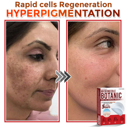 Fivfivgo® MicroNeedle Botanic Skin Tag Removal Patch 🇺🇸 Made in the USA