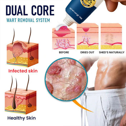 Oveallgo® Genital Warts Remover Cream 👨Designed for Men