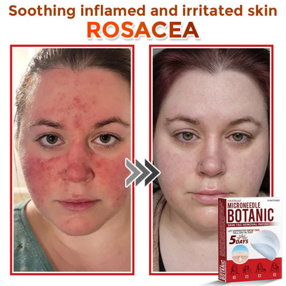 Fivfivgo® MicroNeedle Botanic Skin Tag Removal Patch 🇺🇸 Made in the USA