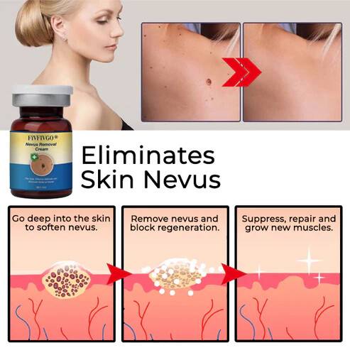 Fivfivgo® Nevus Removal Cream