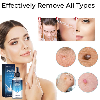 Fivfivgo® Fast Skin Tag Remover for All Skin Types